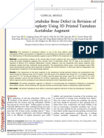 Orthopaedic Surgery - 2023 - Ying - Treatment of Acetabular Bone Defect in Revision of Total Hip Arthroplasty Using 3D