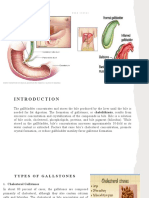 CHOLELITHIASIS