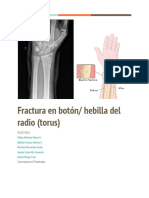 Fractura en Botón