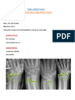 Bone Fracture Detection