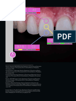 Veneer and Crown Shade Matching A Digital Approach