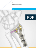 Acumed Surgical Technique ES Acu Loc 2 ESHNW00 06 C