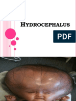 Hydrocephalus