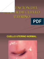 CA de Cuello Uterino