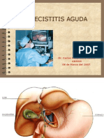 Colecistitis Aguda