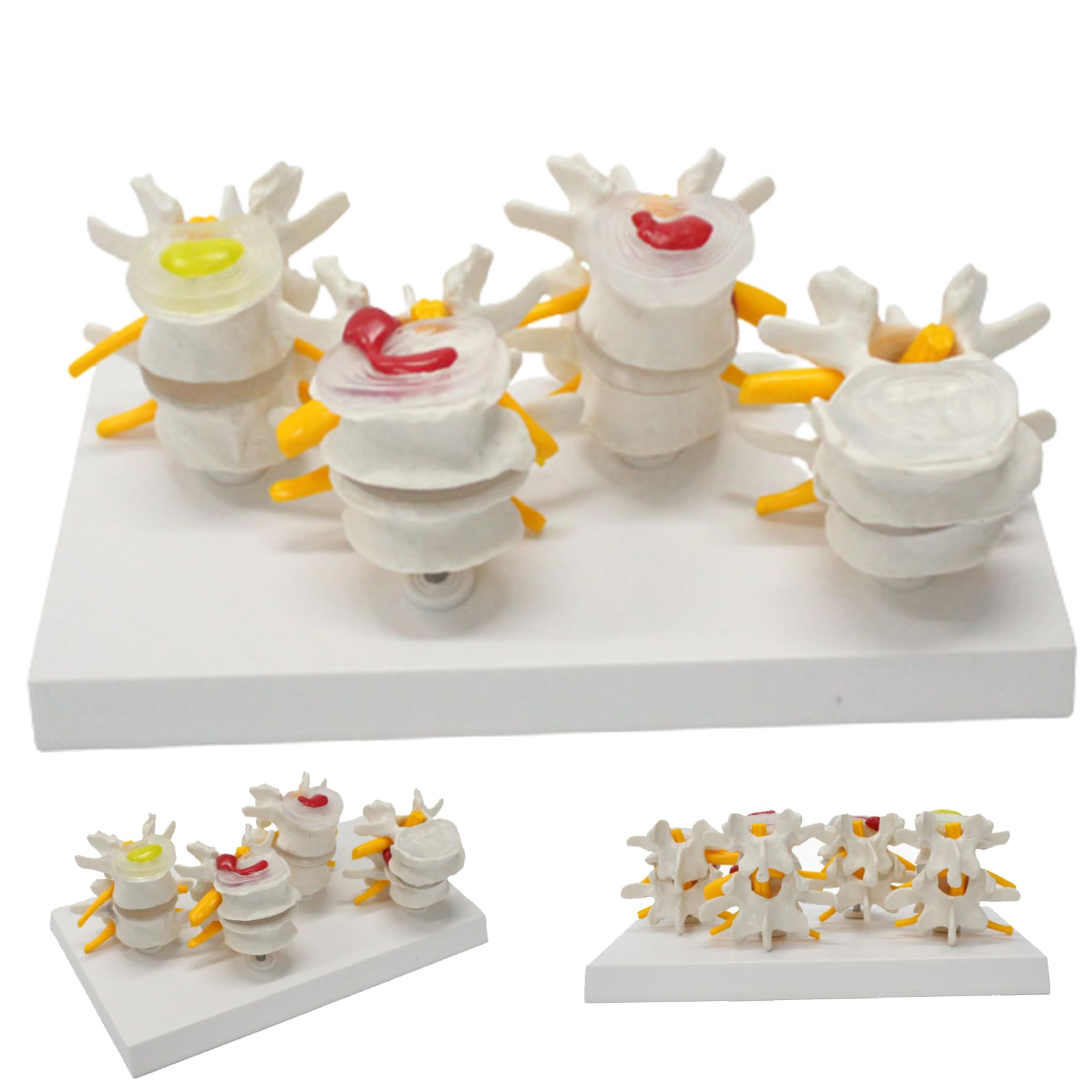 HemoreSpine Model, 4pcs/set Simulation 4-Stage Diseased Lumbar Spine Comparison Model, PVC Proportional Lumbar Spine Model for Teaching & Learning