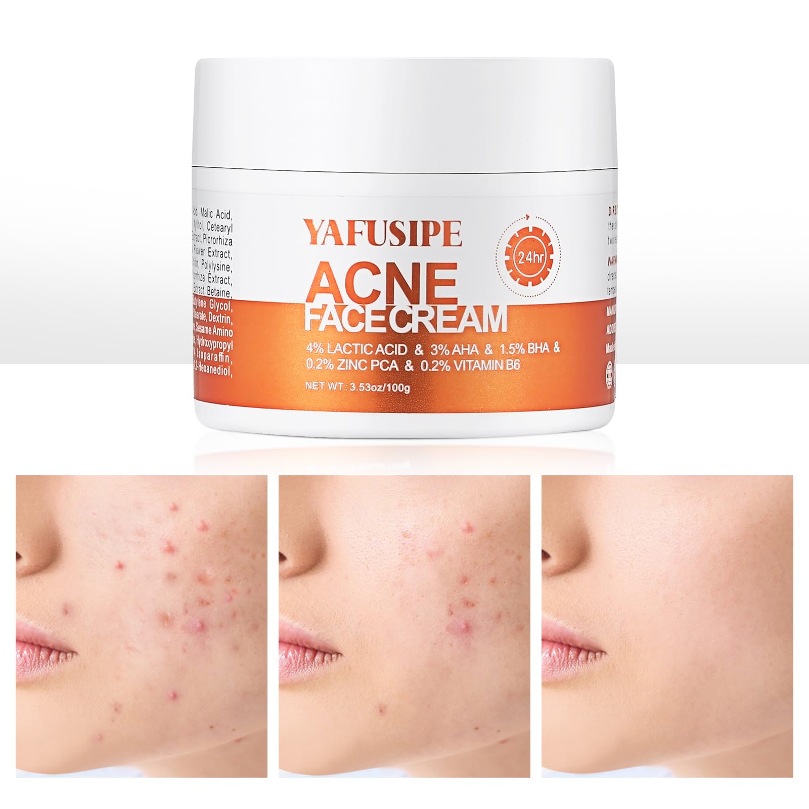 Acne Treatment for Face, Acne Cream Back Acne Treatment Cream for Teens & Adults Anti-acne Pimple Cream Butt Acne Clearing Cream, Acne Spot Treatment