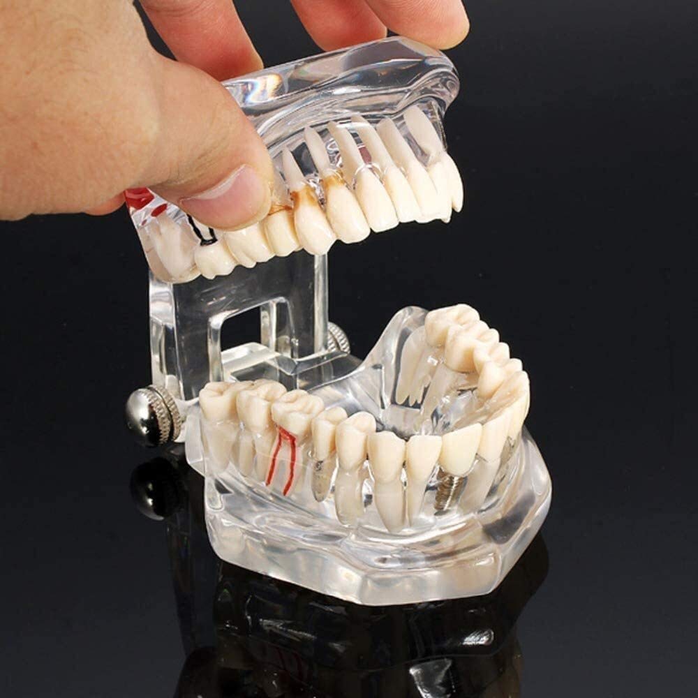 Disease Teeth Hot Dental Implant Model for Medical Science Dental Disease Teaching Study with Restoration Bridge Tooth Dentist 0827 Model