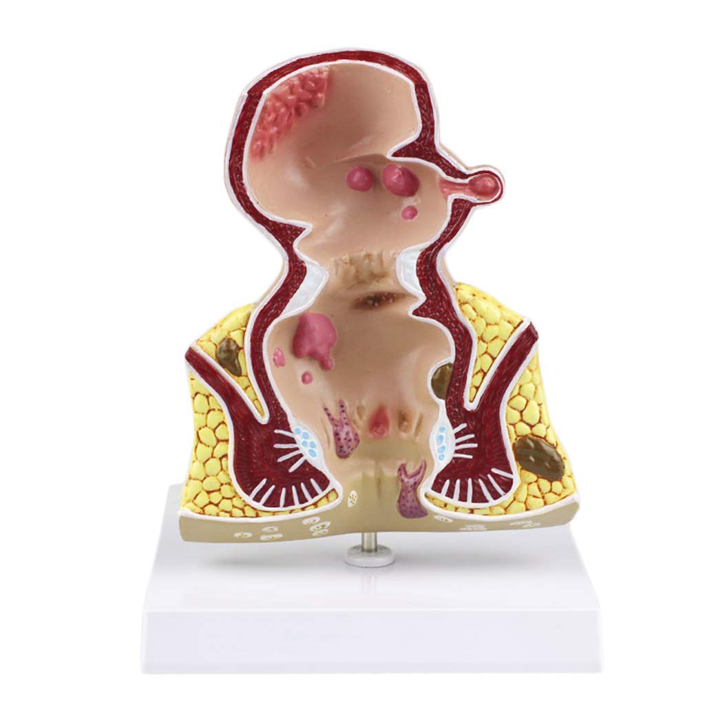 Pathologique Rectal Modèle - Anatomie Système digestif Humain Modèle - Modèle Rectal - Humain Rectal Pathologique Lésion Modèle