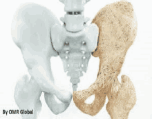 a model of a pelvis with a healthy pelvis and a damaged pelvis .