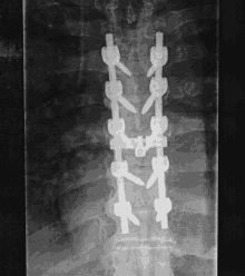 a black and white x-ray of a person 's spine with a few screws in it