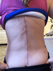 a woman 's back with a surgical scar on it