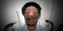 a man in a hospital bed has a huge red nose