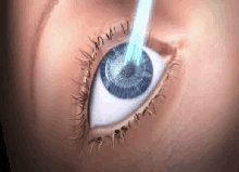 a close up of a person 's eye with a laser being applied to it .