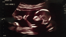 an ultrasound image of a baby with the letters bag arm 2 on it