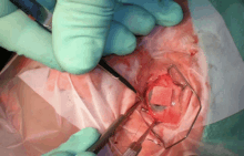 a surgeon is using a pair of tweezers to remove a piece of tissue