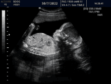 a black and white ultrasound image of a baby dated 30/7/2022