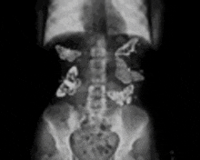 a black and white x-ray of a person 's stomach and kidneys with butterflies in it .