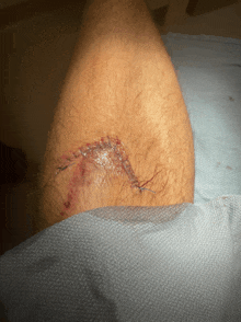 a close up of a wound on a person 's leg with stitches