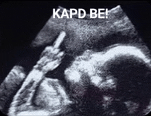 an ultrasound of a baby with the words kapd be written on the bottom