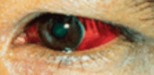 a close up of a person 's eye with a red eye .