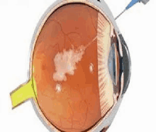 a computer generated image of a human eye with a needle in it .