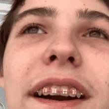 a young man with braces on his teeth looks up at the camera