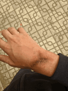 a close up of a person 's wrist with a stitched wound