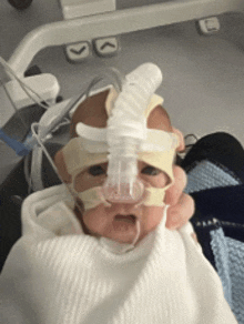 a baby wearing an oxygen mask is in a hospital bed