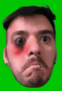 a man with a beard and a black eye has a red spot on his face