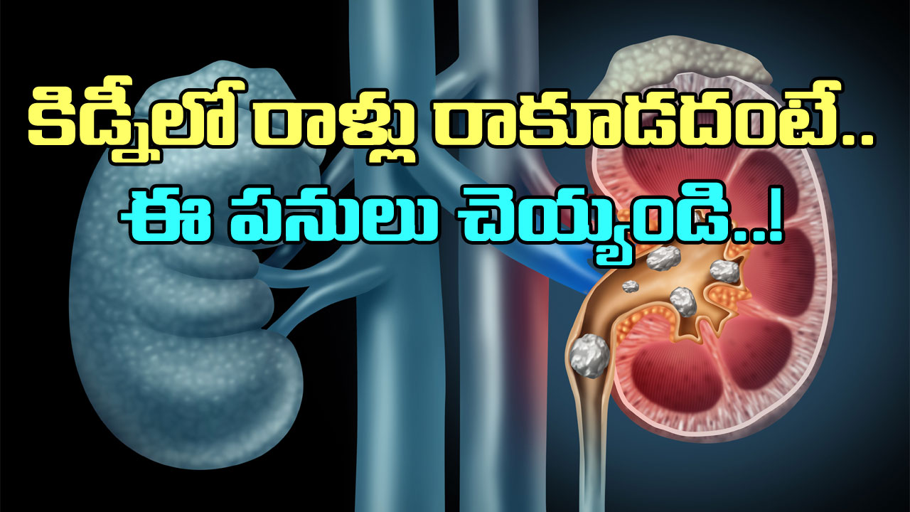 Kidney Stones: కిడ్నీ స్టోన్స్ రాకూడదంటే ఏం చేయాలి? ఈ 6 చిట్కాలు ...