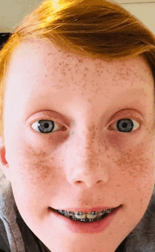 a young boy with freckles and braces on his teeth