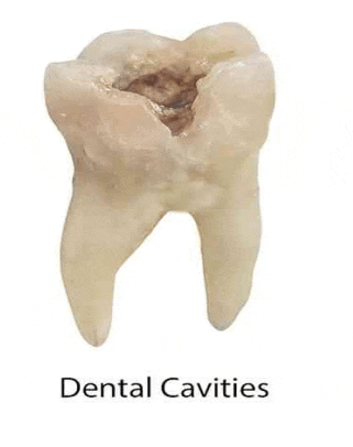 a close up of a tooth with a hole in it and the words `` dental cavities '' underneath it .