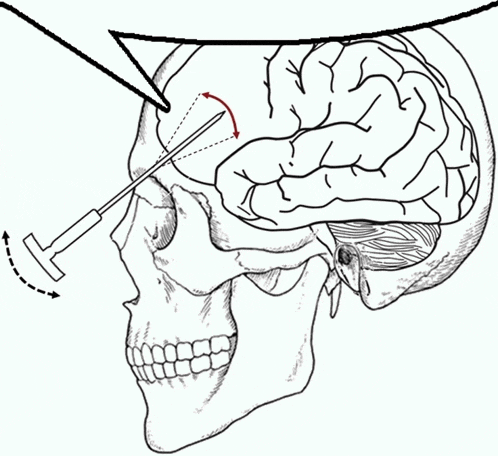 a black and white drawing of a skull with a needle in the brain