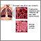 COPD (chronic obstructive pulmonary disorder)