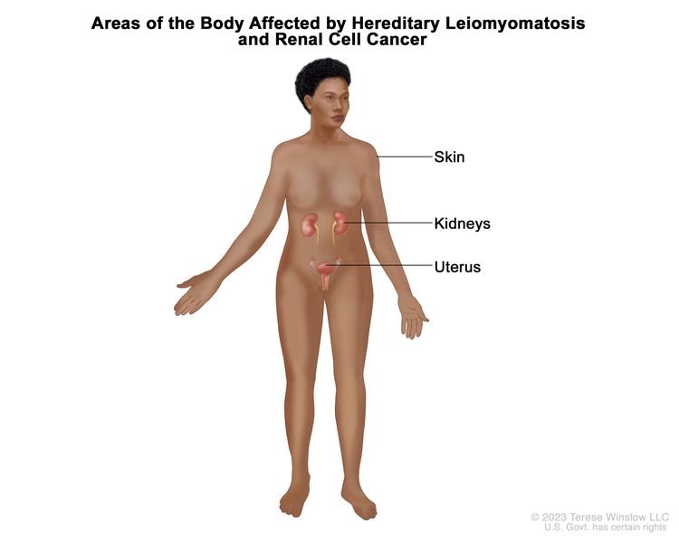 Drawing showing areas of the body affected by hereditary leiomyomatosis and renal cell cancer, including the skin, kidneys, and uterus.