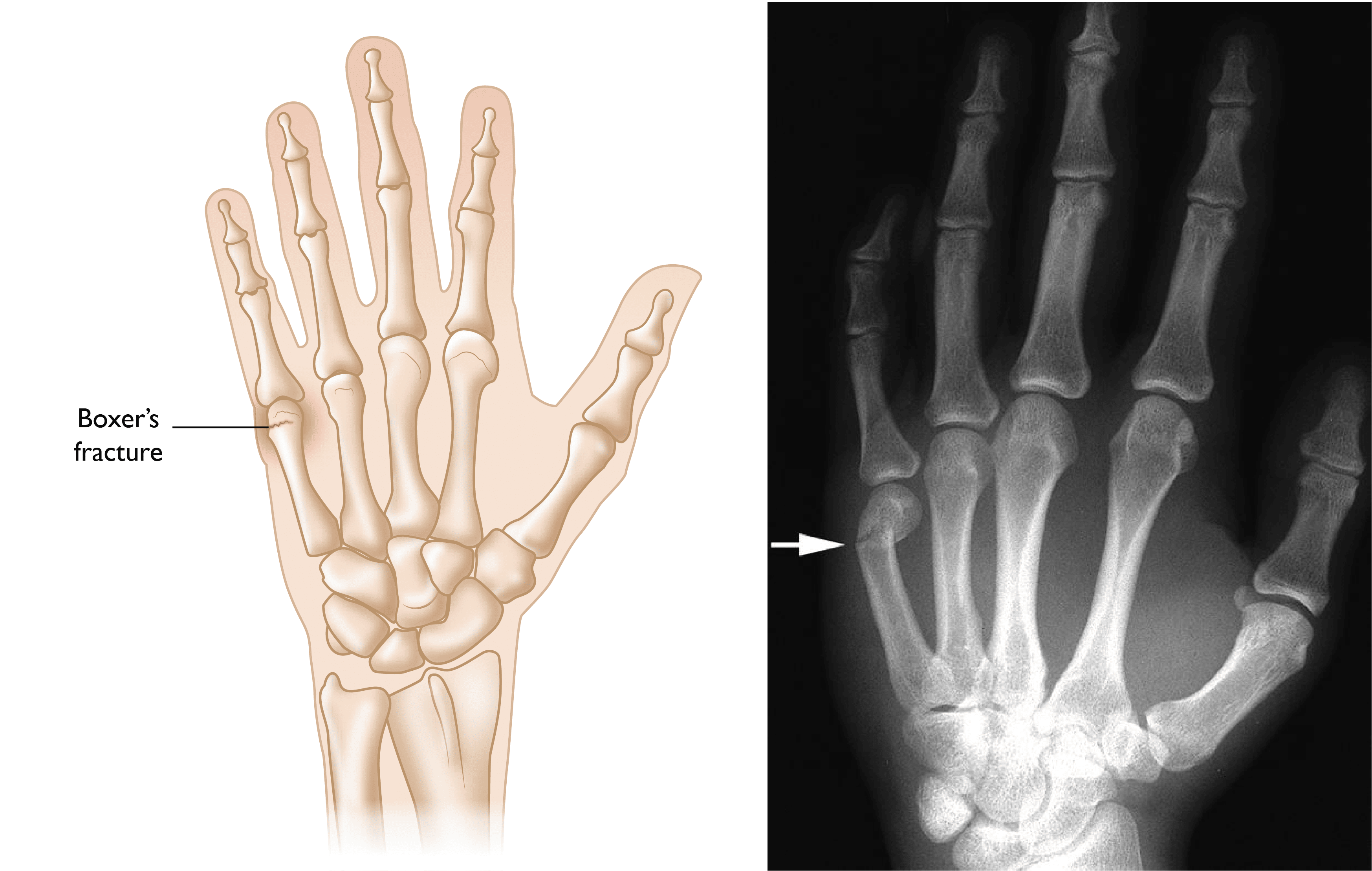 Broken Index Finger X Ray