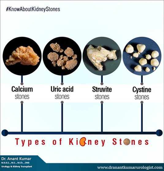 Uric Acid Stone