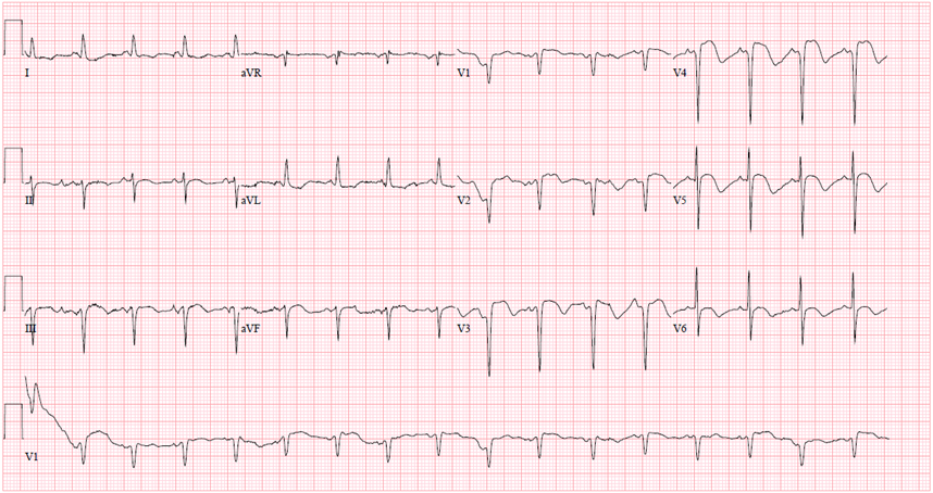 Figure 2 EKG Showing Normal Sinus Tachycardia Q Waves In V1 V2 Leads ...