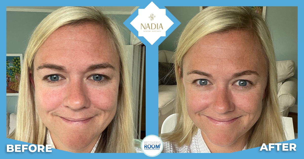 NADIA Skincare before and after with Katie.