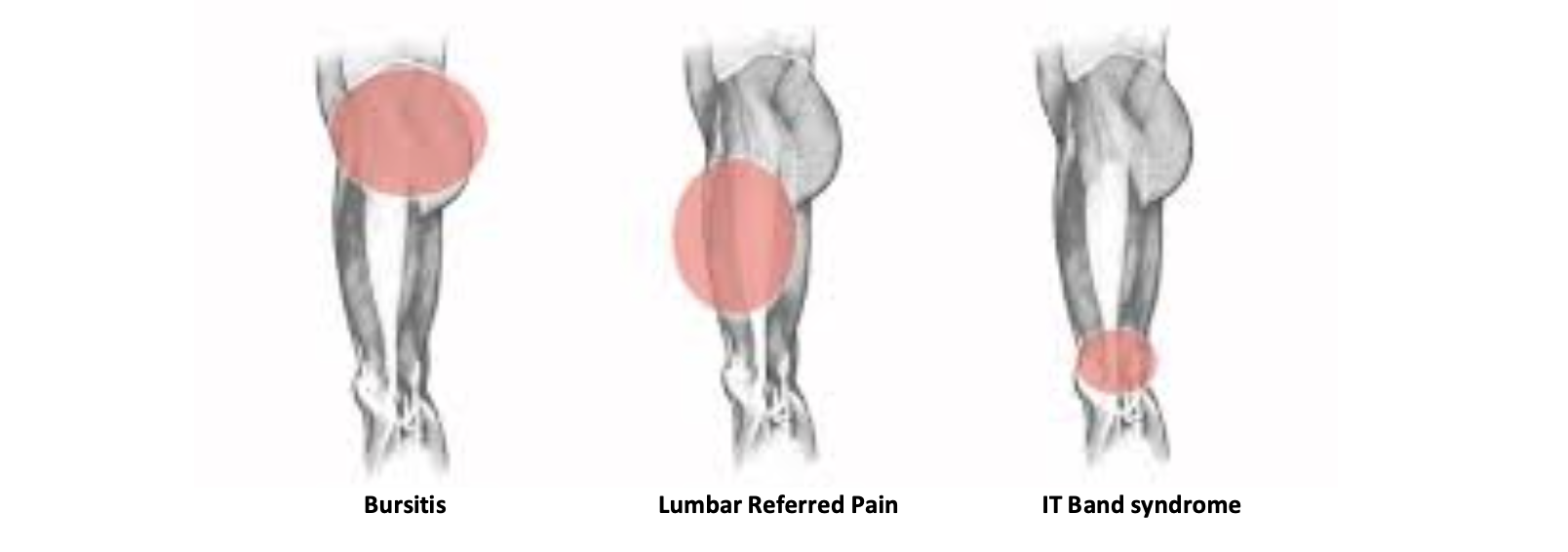 Diagnosing Lateral Thigh Pain: IT Band Syndrome, Hip Bursitis And ...