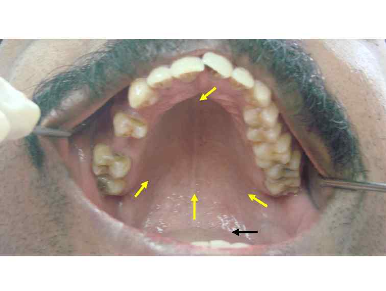 Palate Cancer