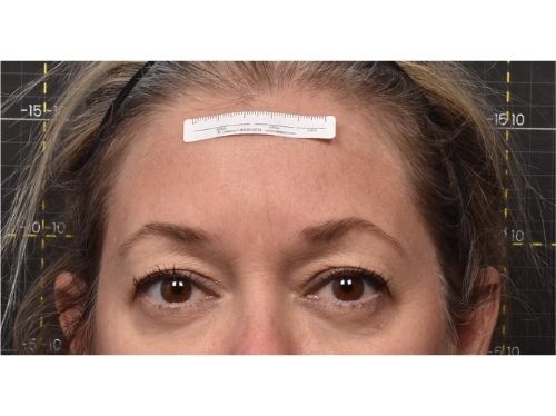 Eyebrows after Sofwave treatment