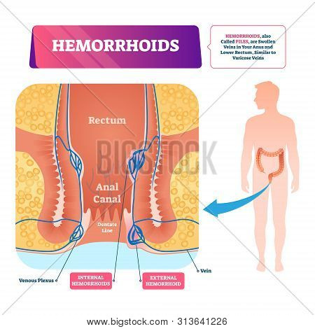 Hemorrhoids Vector Illustration. Labeled Anatomical Vascular Piles Scheme. Diagram With Swollen Vein