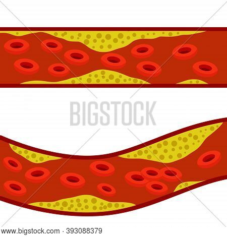 Blood Cholesterol. Veins And Arteries With Fat. Problem With Vascular System. Scientific Educational