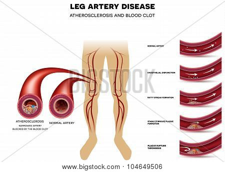 Leg Artery Disease, Atherosclerosis