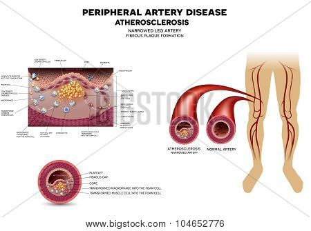 Leg Artery Disease, Atherosclerosis