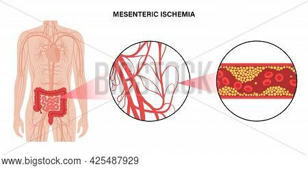 Mesenteric Ischemia, Cholesterol In Human Blood Vessels. Colitis In Intestine. Fat Cells In Vein Art