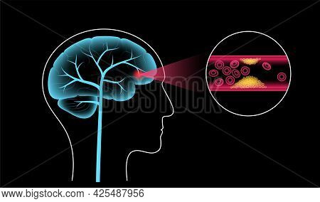 Ischemic Brain Stroke, Arteriosclerosis. Infarct, Tia, Cva Concept. Cholesterol In Blood Vessel. Fat