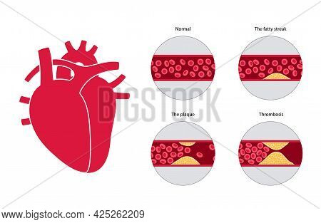 Cholesterol In Human Blood Vessels And Heart Logo. Fat Cells In Vein Artery. High Ldl And Hdl Level.